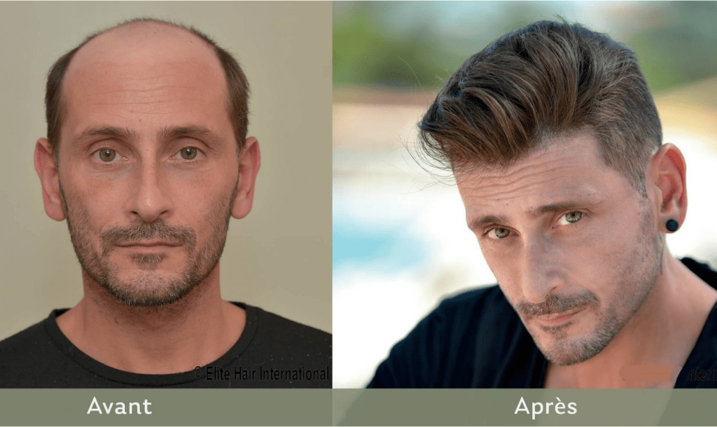complément capillaire sur mesure